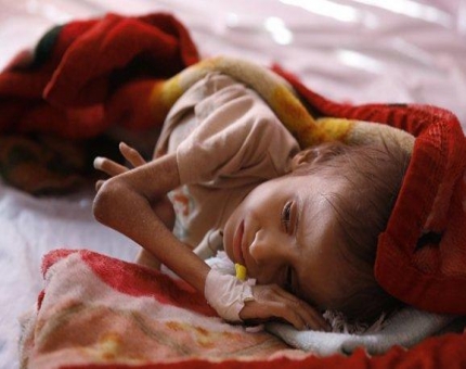 وفاة 190 طفلا في اليمن بالكولير