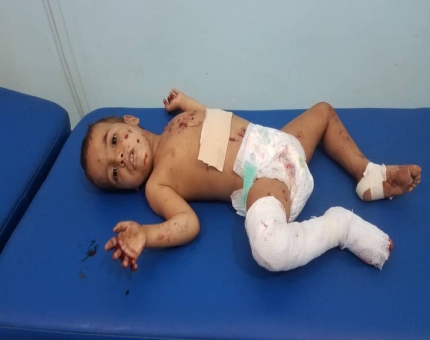 إصابة طفل بقصف للميلشيا جنوب الحديدة